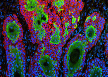 Geni-etichetta riconoscono le impronte digitali dei tumori