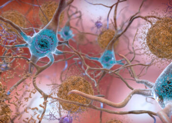 Le placche dell’Alzheimer distrutte con luce e suoni