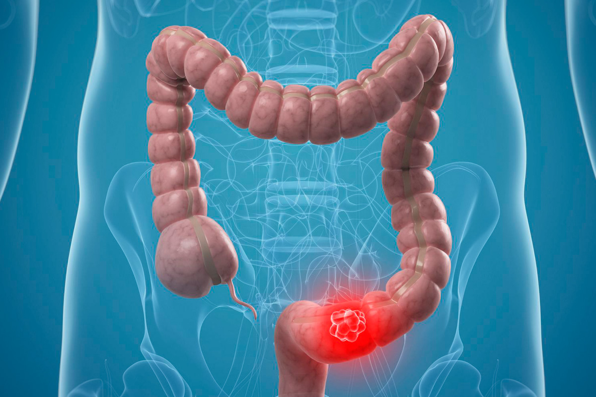 “Stop darmkanker” fermiamo il cancro al colon