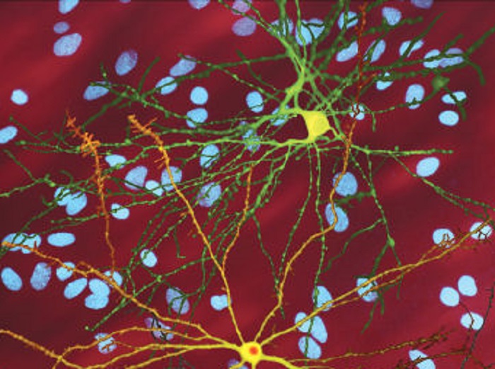 Nuove ‘brecce’ per attaccare la malattia di Huntington