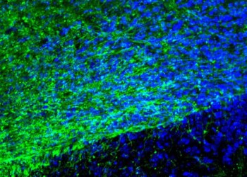 Sclerosi multipla, smascherati i veri ‘vandali’ del cervello