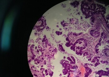 Tumori, un modello matematico svela le metastasi fantasma