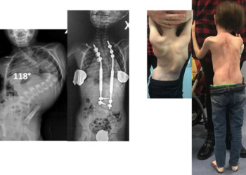 Barre magnetiche per rara scoliosi bimba