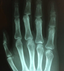 Villa Mafalda, le tipologie di reumatismi