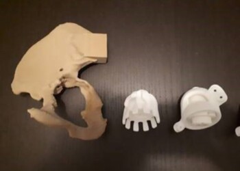 Protesi anca in 3D impiantata a Ferrara