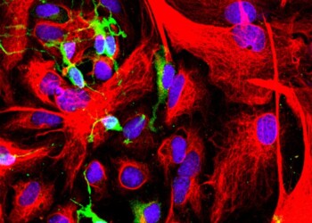 Sclerosi multipla, riparate le lesioni nel cervello dei top
