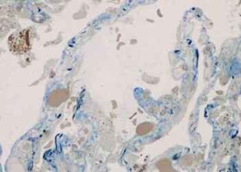Il coronavirus provoca anche embolie ‘grassose’ nei polmoni