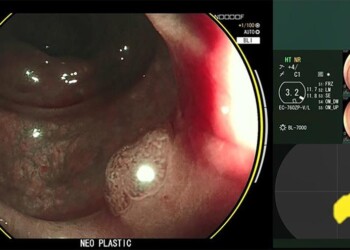 Colonoscopia con l’occhio dell’IA
