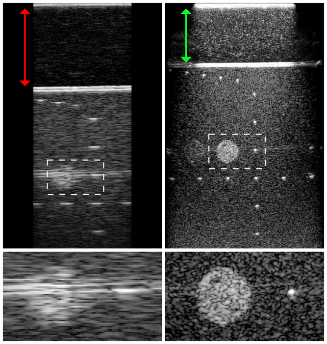 Un algoritmo migliora risoluzione immagini ecografiche