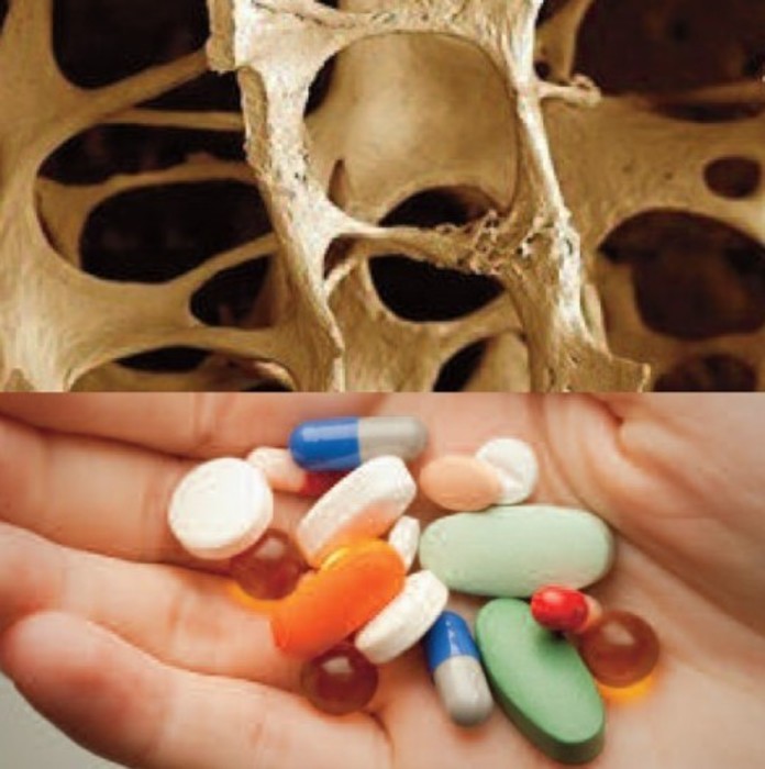 Osteoporosi per 4,5 mln italiani,cure inadeguate in 80% casi