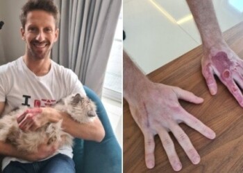 F1: Grosjean, tolte le bende, fa vedere le sue mani