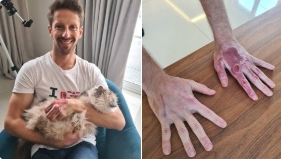 F1: Grosjean, tolte le bende, fa vedere le sue mani