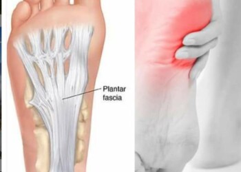 Come prevenire e curare la fascite plantare