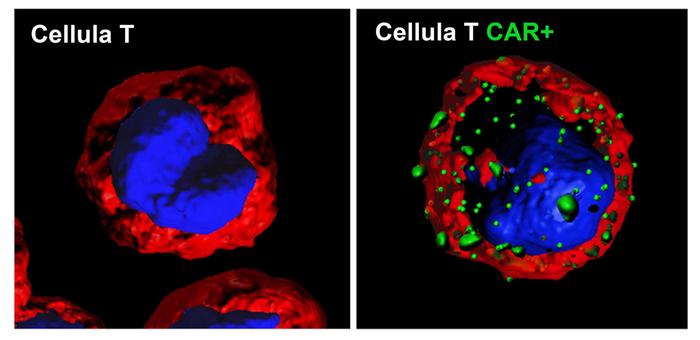 Bimbi con leucemia guariti grazie a terapia cellule Car-T