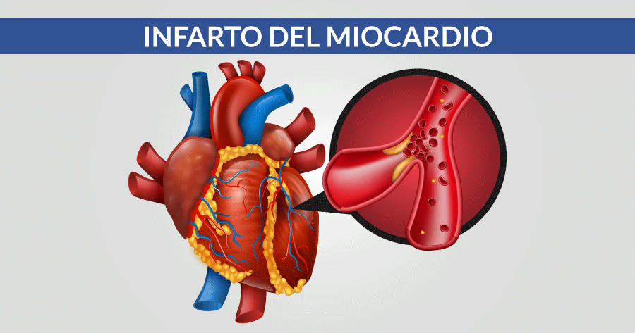 Ricerca:via studio Registro infarto miocardico no-ST-elevato