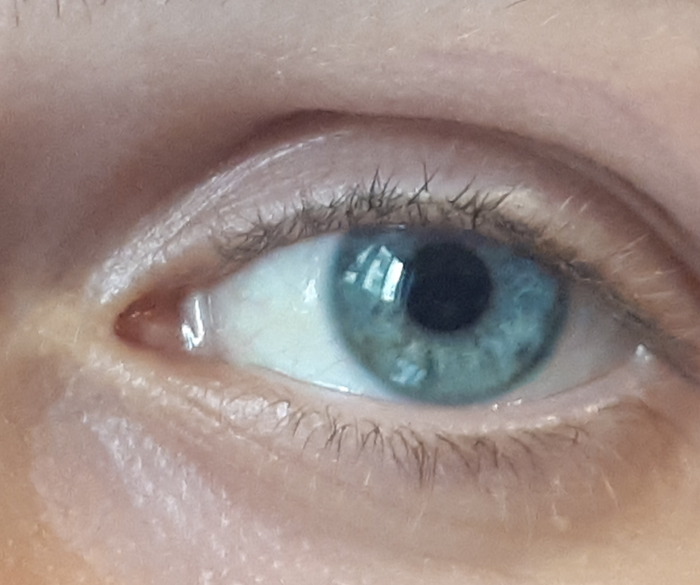 Startup romana crea dispositivi per evitare trapianto cornea