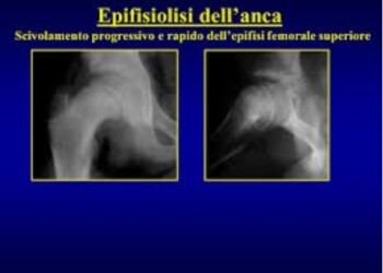 epifisiolisi dell'anca
