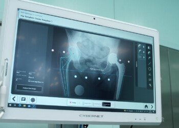 Un navigatore computerizzato per le protesi d’anca: interventi personalizzati nell’ordine del millimetro