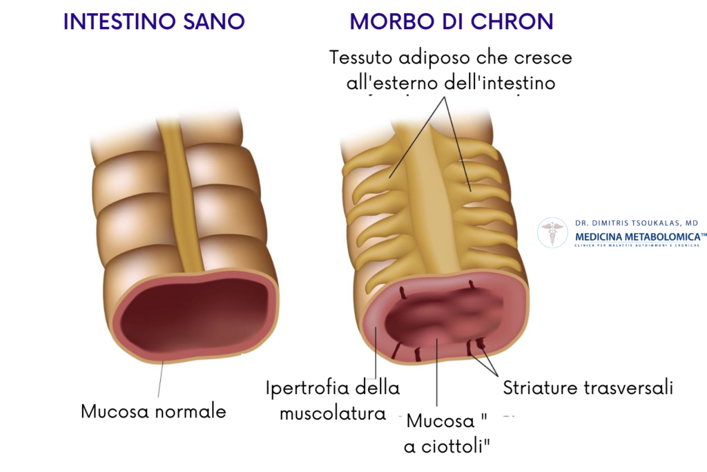 Il morbo di Crohn provoca un’infiammazione che può coinvolgere l’intera parete intestinale.