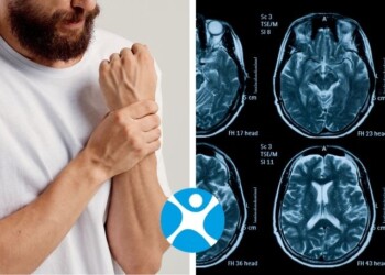 Atrofia Muscolare Spinale