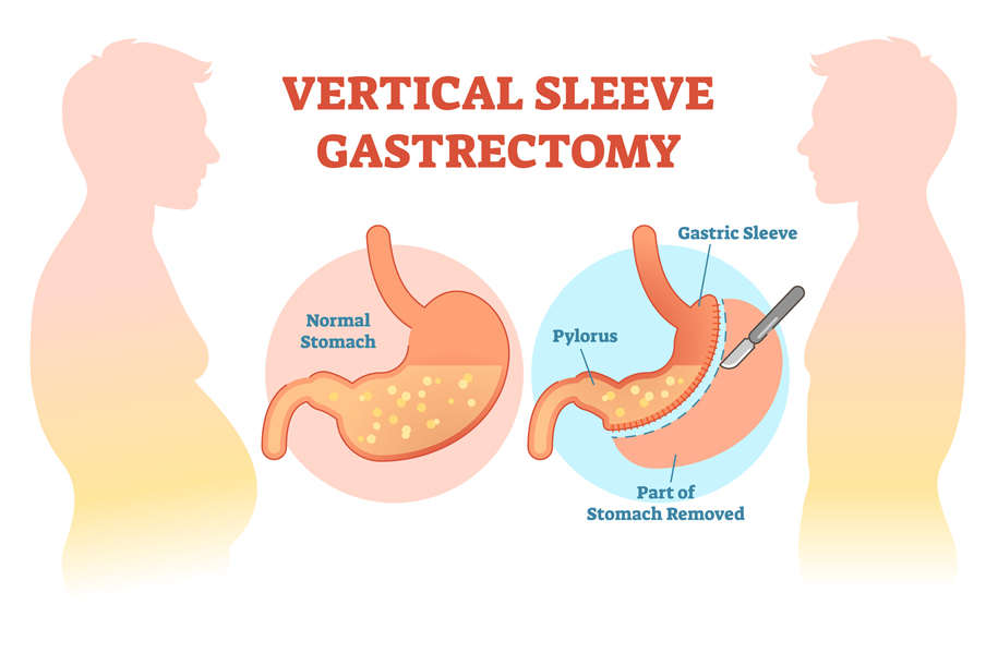 sleeve gastrectomy