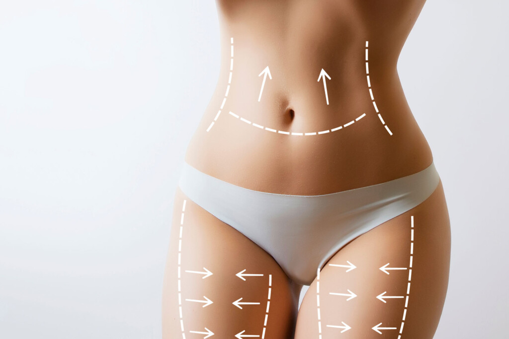 rispettando le linee guida post-operatorie, la liposuzione può essere un'opzione sicura ed efficace per modellare il corpo.