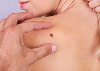 Melanoma, 2024 anno ‘nero’: +30% di diagnosi. Cresce l’immunoterapia.