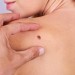 Melanoma, 2024 anno ‘nero’: +30% di diagnosi. Cresce l’immunoterapia.